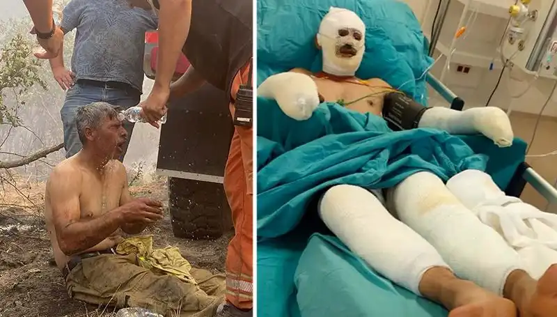 Yanmış Orman İşçisi İçin Umut Verici Gelişmeler: Tedavi Süreci Devam Ediyor
