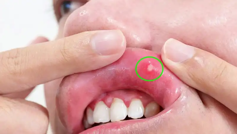 Kanser Belirtilerini Göz Ardı Eden Adamın Üzerine Düşündüren Hikayesi